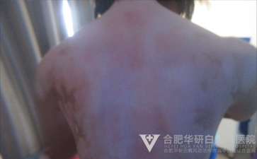 护理白癜风,白癜风护理要点