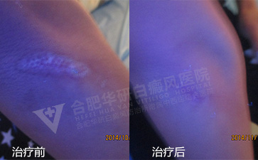 诊断白癜风,诊断白癜风要点