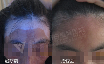 头部白癜风,头部得白癜风